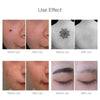 Laser Freckle Tattoo Removal Mole Dark Spot Eyebrow Pigment Laser Acne Treatment