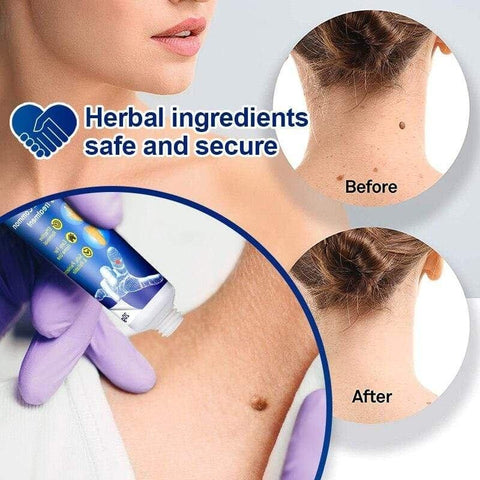 Herbal Extract Warts Remover Antibacterial Cream Skin Tag Remover