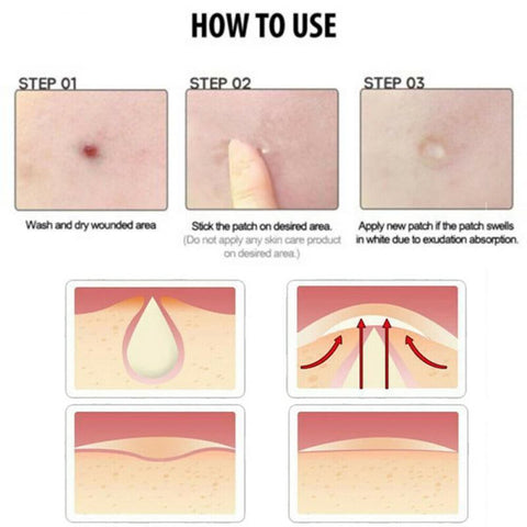 Pimple Remover Master Patch Acne Treatment